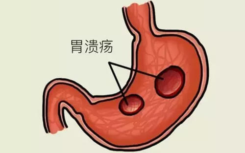 胃溃疡症状表现