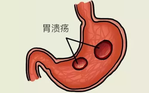 胃溃疡症状表现有哪些