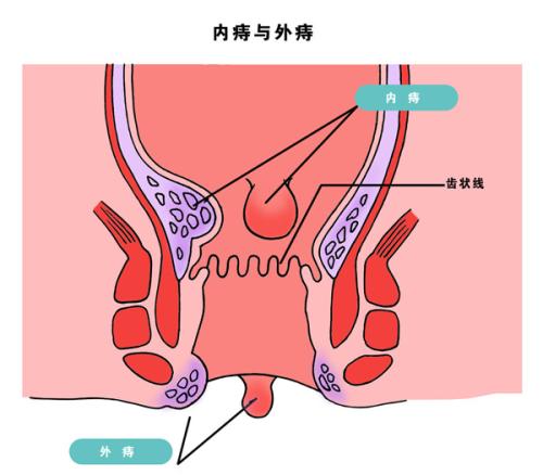 外痔的肉球