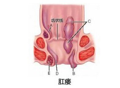 肛瘘手术