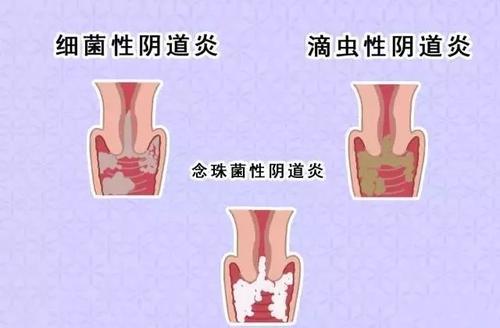 治疗阴道炎费用大概多少钱