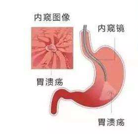 胃疼有必要做胃镜吗