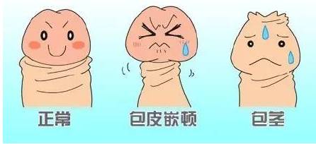 嘉定包茎过长手术什么费用