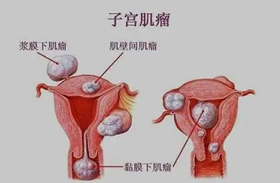 子宫肌瘤：这5种情况，一定马上切除！