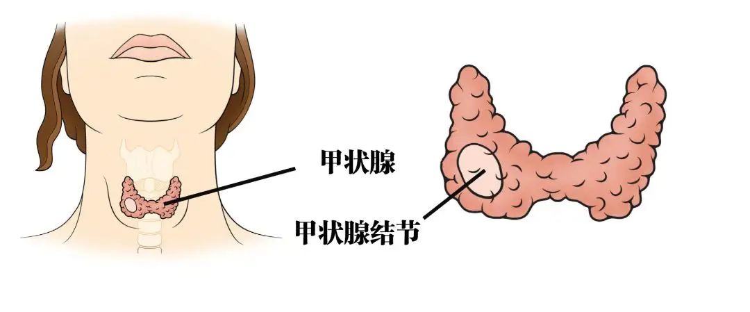 甲状腺结节不一定是癌！这些知识你要了解！