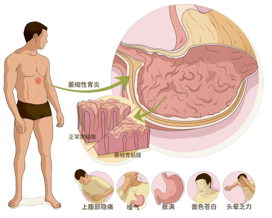 这些消化道疾病都可能变成癌，一定要早发现早治疗！