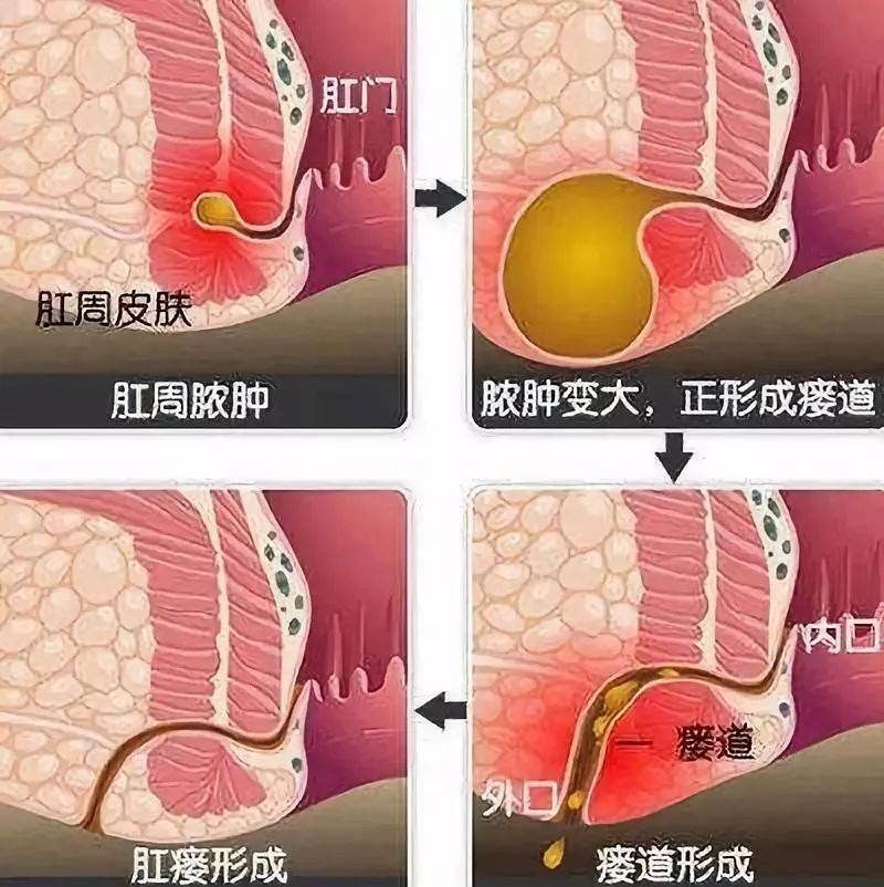 菊部地区冒出小疙瘩，又疼又痒？可能是肛瘘！