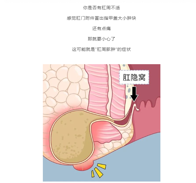 菊部地区又痒又痛，还长包？可能是肛周脓肿！