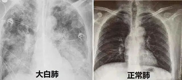 警惕“白肺”！建议这五类高危人群，在阳康后做一次全身体检！