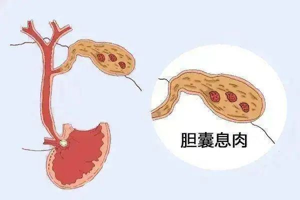 体检发现了胆囊息肉，该切还是不该切？