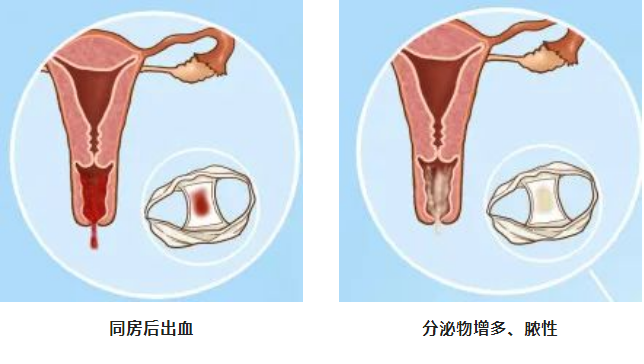 原来，这些生活习惯，更容易引发宫颈炎！