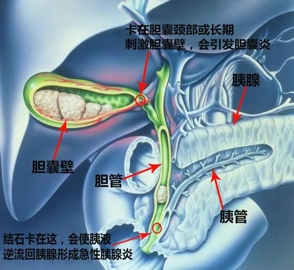 春节后胆结石频频发作，这几个防护小知识你一定要知道