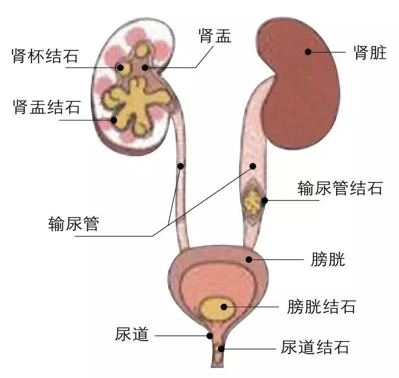 要么不痛，痛起来要人命之肾结石