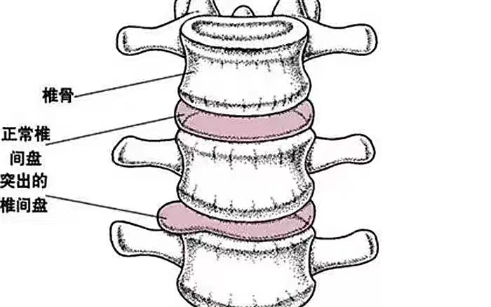 【护理科普】腰疼难忍？腰椎间盘突出应如何预防？