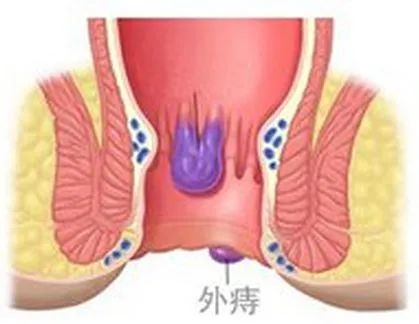 肛门旁边长暗紫色包块 小心血栓外痔找上门