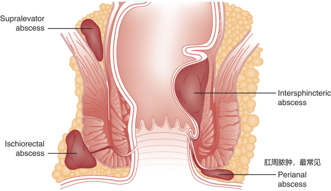“菊”部肿了个包？你可能是得了肛周脓肿！