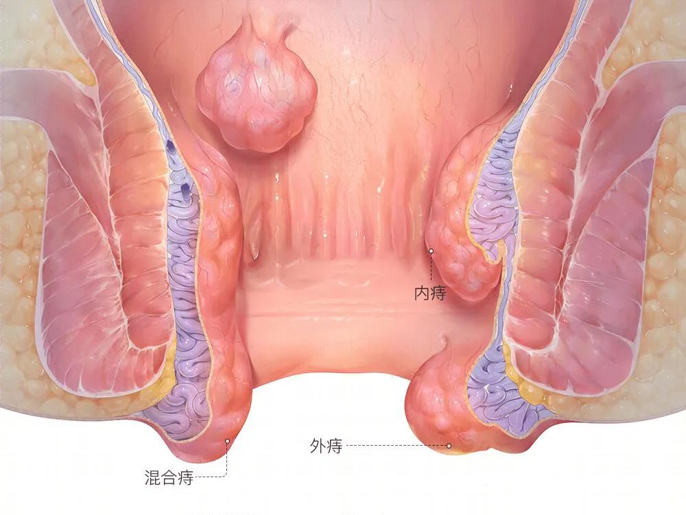 血栓性外痔通常如何治疗？