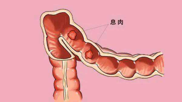 沉默的杀手——肠息肉，不经意间就会癌变！