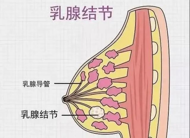 体检查出乳腺结节，会变成癌吗？一个办法教你分辨！