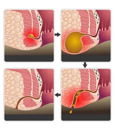 关于肛瘘，你很关心的3个问题