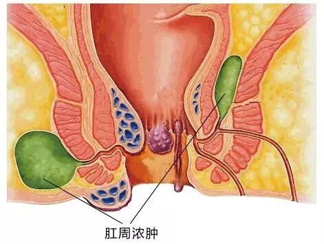 想让屁股少遭罪，肛周脓肿你必须了解！