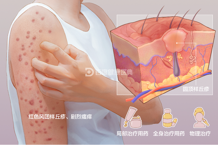 痒、痒、痒…身上突然起痒疹怎么办？