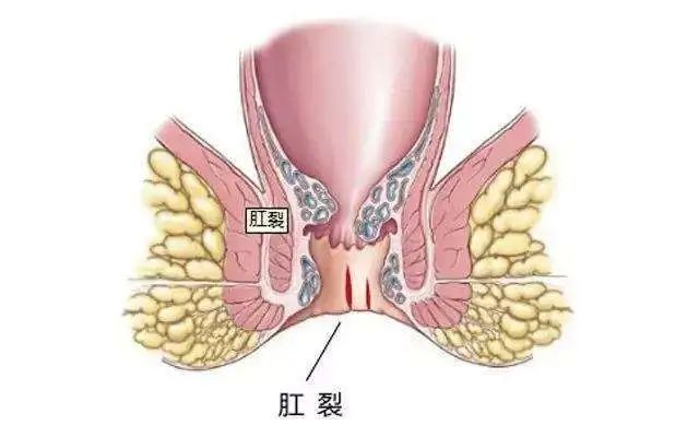 肛裂是什么原因引起的？怎么治疗？